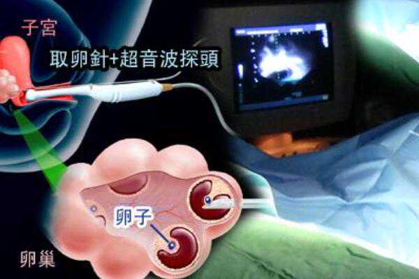北京寻找助孕患者的医院,2023北京二胎产假128天是怎么计算的？